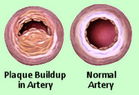 arteries_showing_plaque